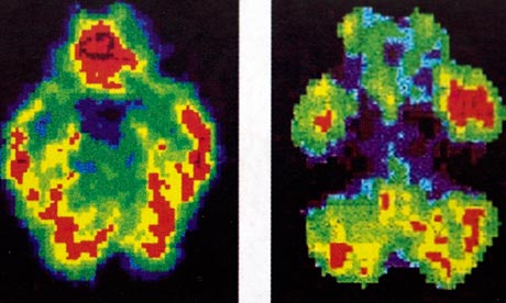Scans of a normal brain, left, beside that of murderer Antonio Bustamante, who was spared the death penalty after a jury was shown these pictures. Photograph: Public domain