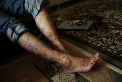 Photographed in 2014, both legs of Syrian opposition activist, aid worker and journalist Karam al-Hamad are scarred from more than 100 cigarette burns he received under torture in a military prison in Damascus for more than a year. (Ayman Oghanna/For The Washington Post)