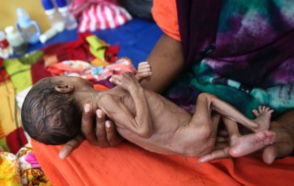 A Somali woman holds her malnourished child as they wait for medical tests at the paediatric ward of Banadir hospital in Mogadishu,