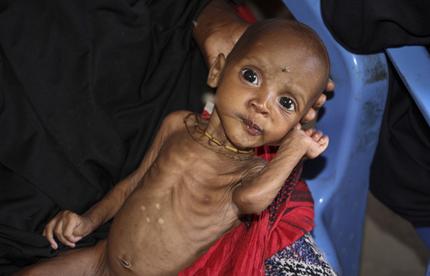 FILE - In this Saturday, Feb. 25, 2017 file photo, malnourished baby Ali Hassan, 9-months-old, left, is held by his mother Fadumo Abdi Ibrahim, who fled the drought in southern Somalia, at a feeding center in a camp in Mogadishu, Somalia. Somalia's prime minister said Saturday, March 4, 2017 that 110 people have died from hunger in the past 48 hours in a single region as a severe drought threatens millions of people. (AP Photo/Farah Abdi Warsameh, File)