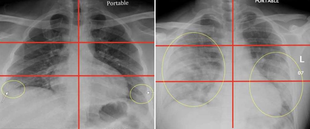 Emergency room chest X-Rays can help predict severity of COVID-19