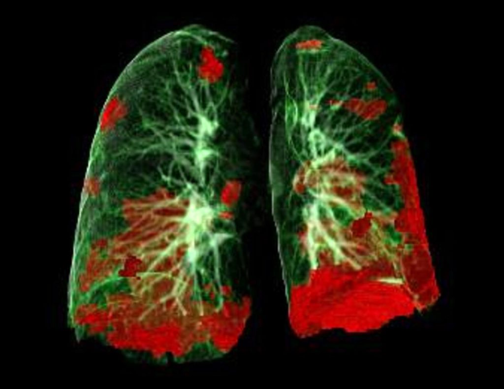 when a pulmonary doctor says he hears dead spaces in lungs, what does it mean