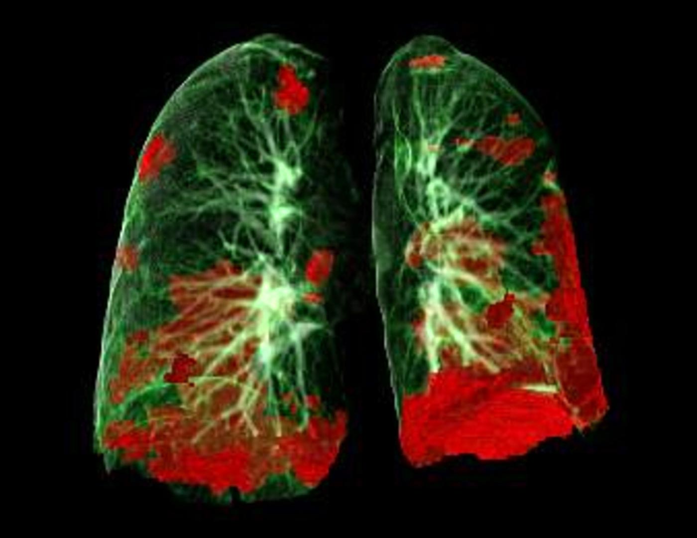 Researchers discover how COVID-19 may trigger fatal levels of  lung inflammation